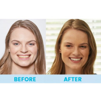 Spark Innovators Spin Smile 360 – Professional Grade Tooth Polisher & Whitener, White. Toothpaste TilyExpress 5